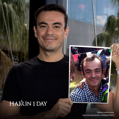 Slider image (1) Hair in 1 Day - Hair Transplant Clinic in Guadalajara